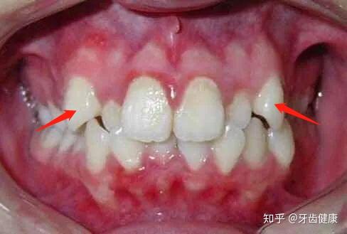 虎牙,也叫犬齿,是上颌处于门牙和臼齿之间的两颗单尖牙,同时,虎牙也是