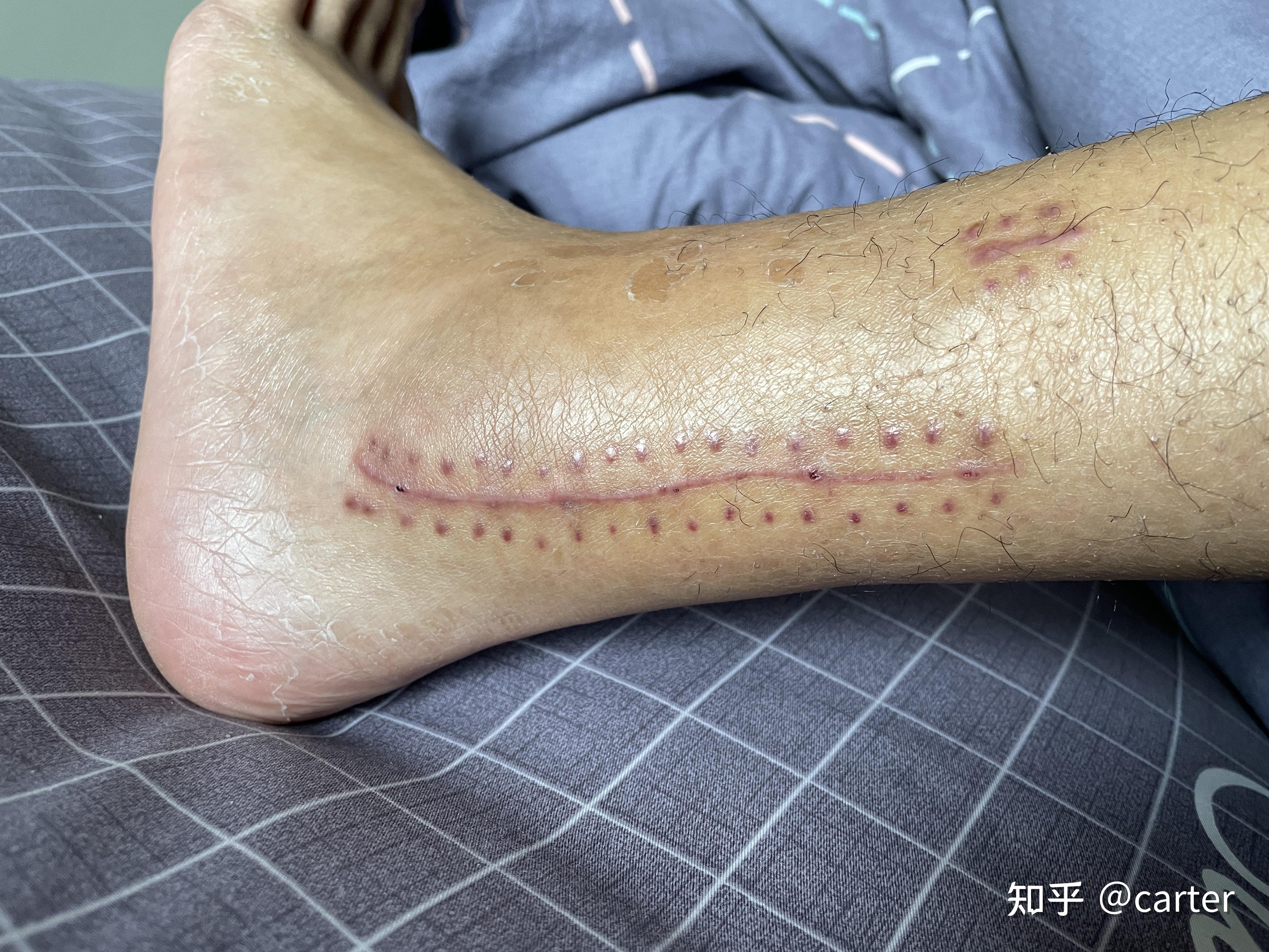 24岁左胫骨腓骨远端骨折及pillon骨折康复记录(有手术刀口图片,比较