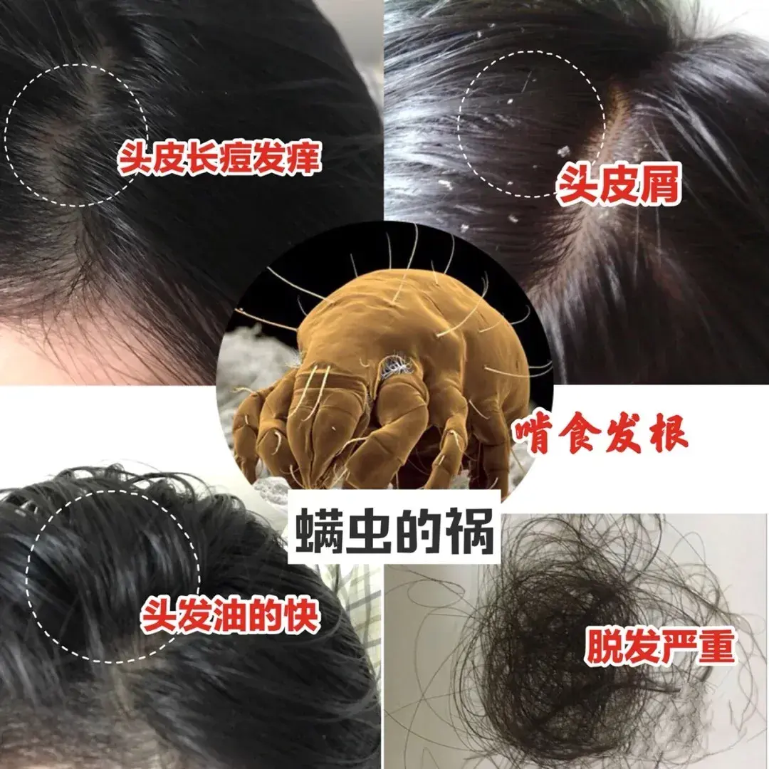 头油头痒竟然需要去医院做检查头上长了这种虫卵要当心