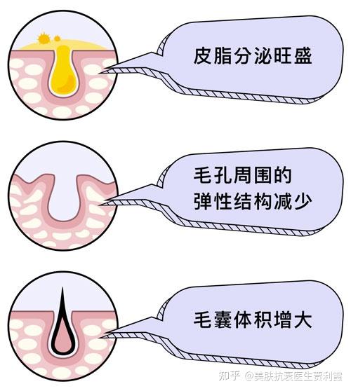 毛孔粗大的原因和类型,改善方法! - 知乎