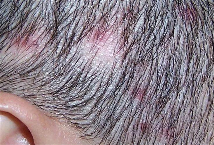 植发后为什么会起毛囊炎如何有效避免
