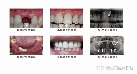 种牙最好的季节是哪个 v2-fd1a80ac671032de7662b023c5850719_r.jpg