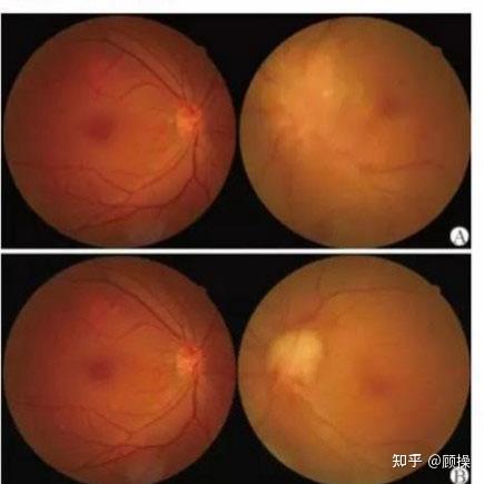 梅毒眼睛红症状图片图片