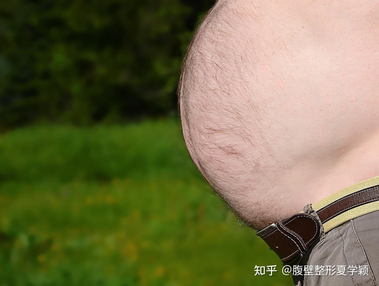 广州慈惠医院腹壁修复外科团队：腹壁整形手术的过程？ - 知乎