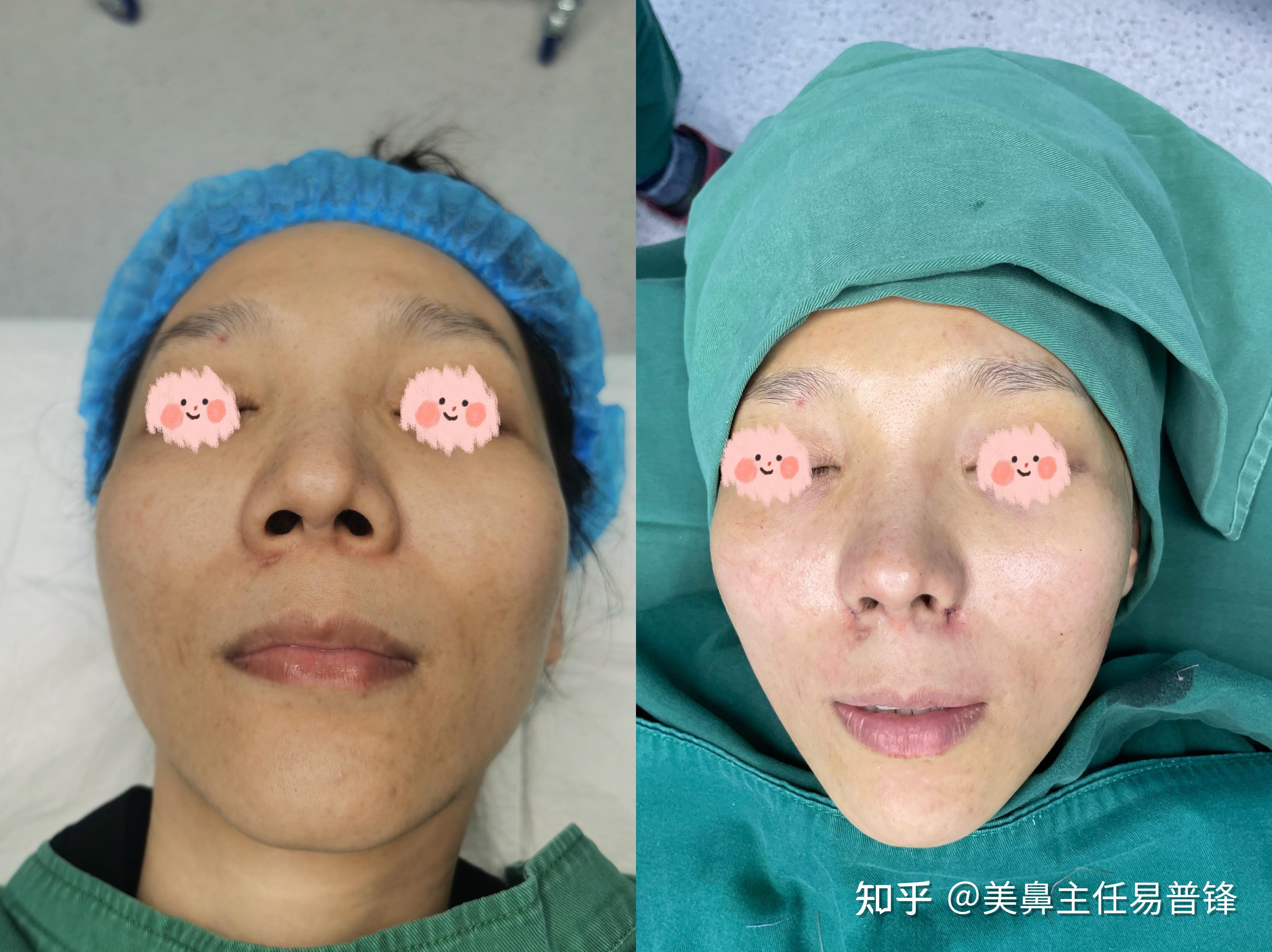 假体取出后鼻翼肥大外扩怎么办