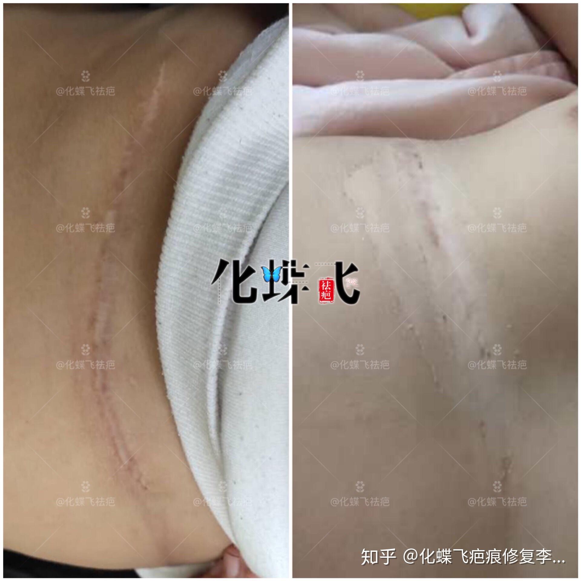 10公分小朋友的手术疤痕修复