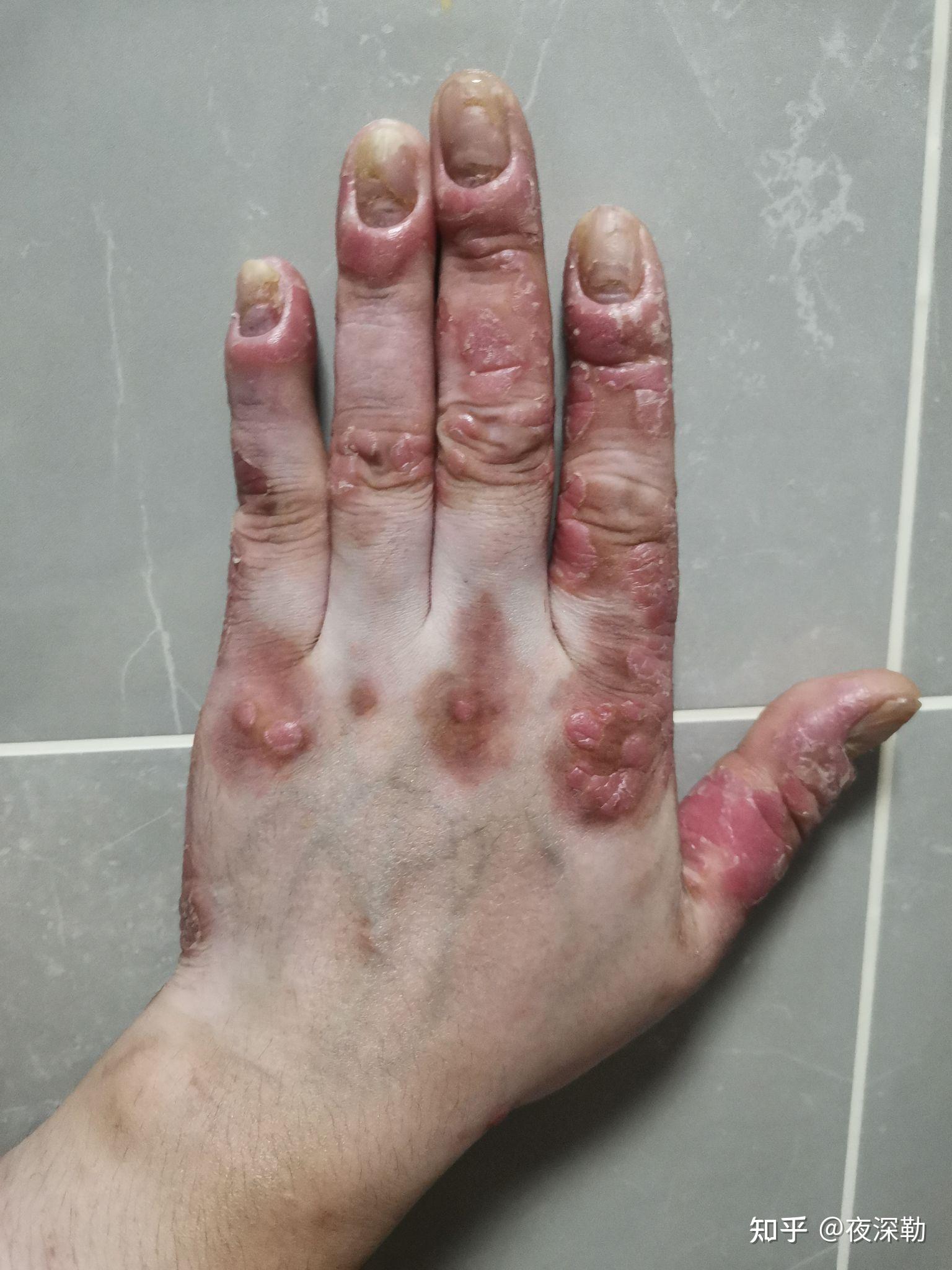 我是多年的银屑病患者记录可善挺司库奇尤单抗的治疗过程