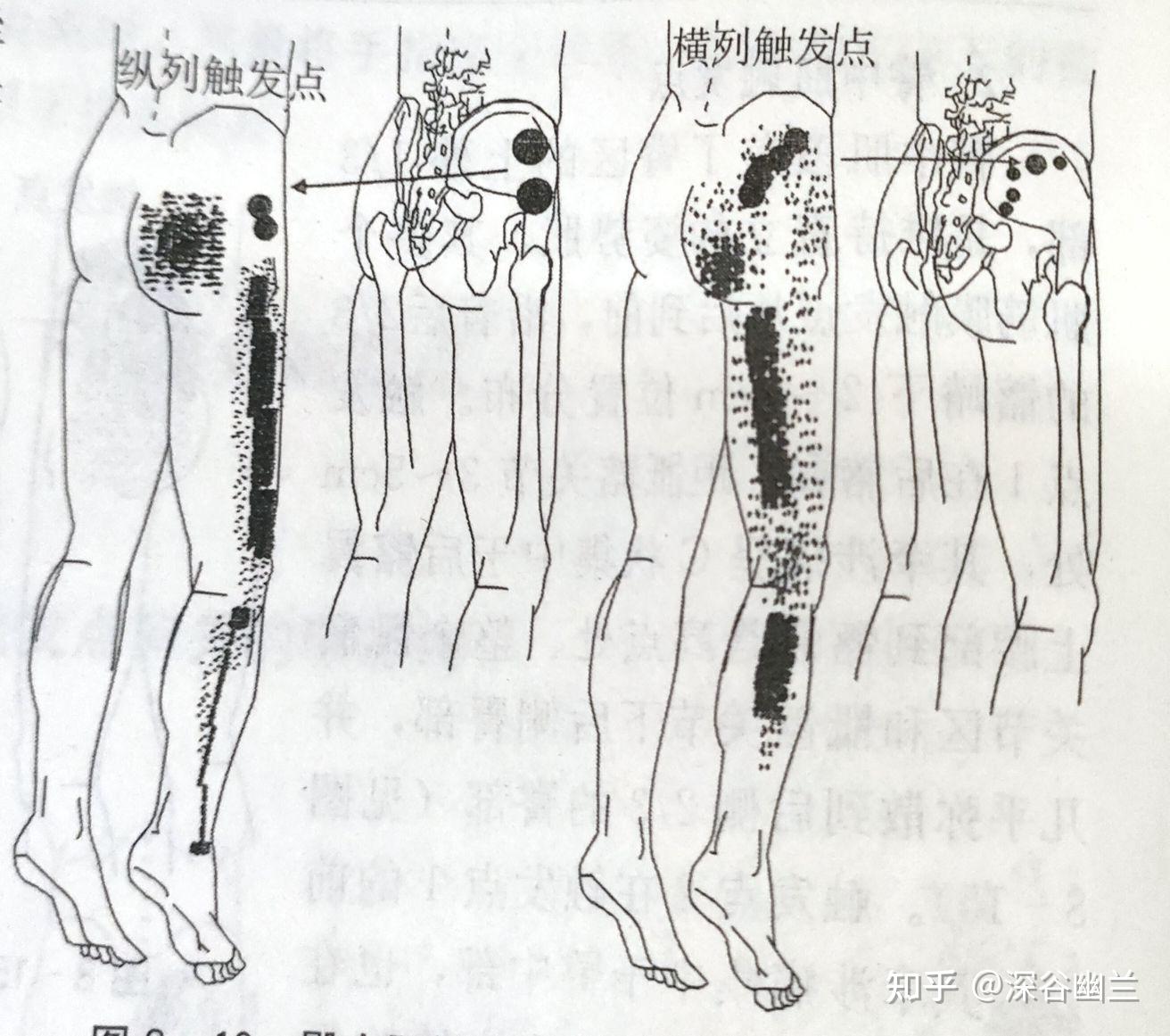 小儿臀中肌定位图片图片