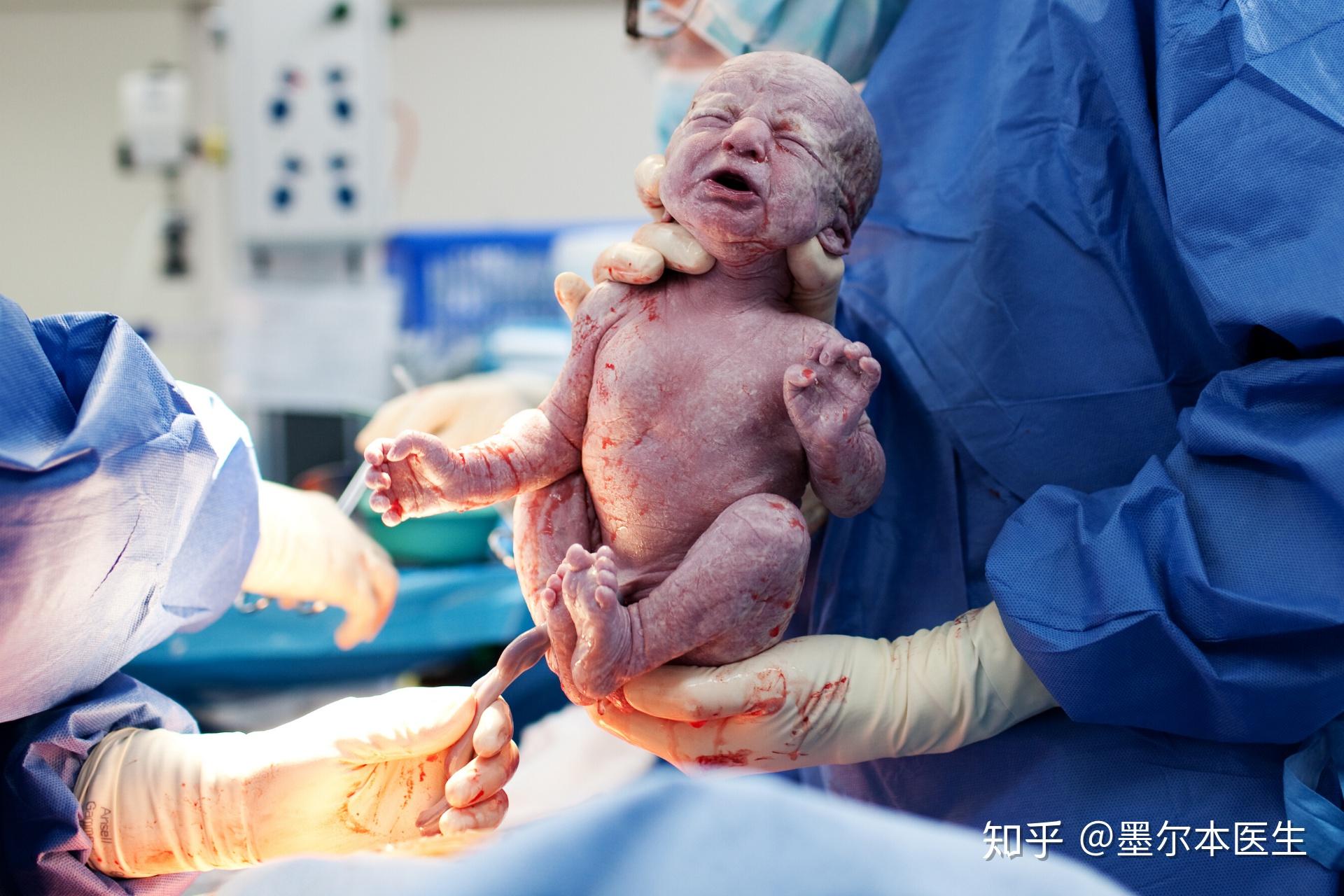 【专科医疗】关于在澳大利亚剖腹产/剖宫产的七大问题 - 知乎