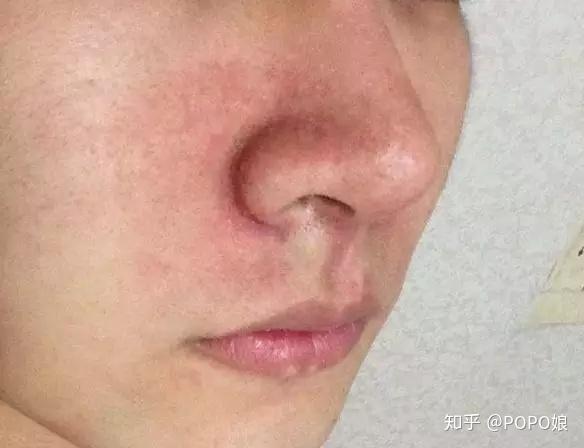 同时有不同程度的瘙痒;泛红问题以鼻翼两侧为主,常伴随着毛孔粗大问题
