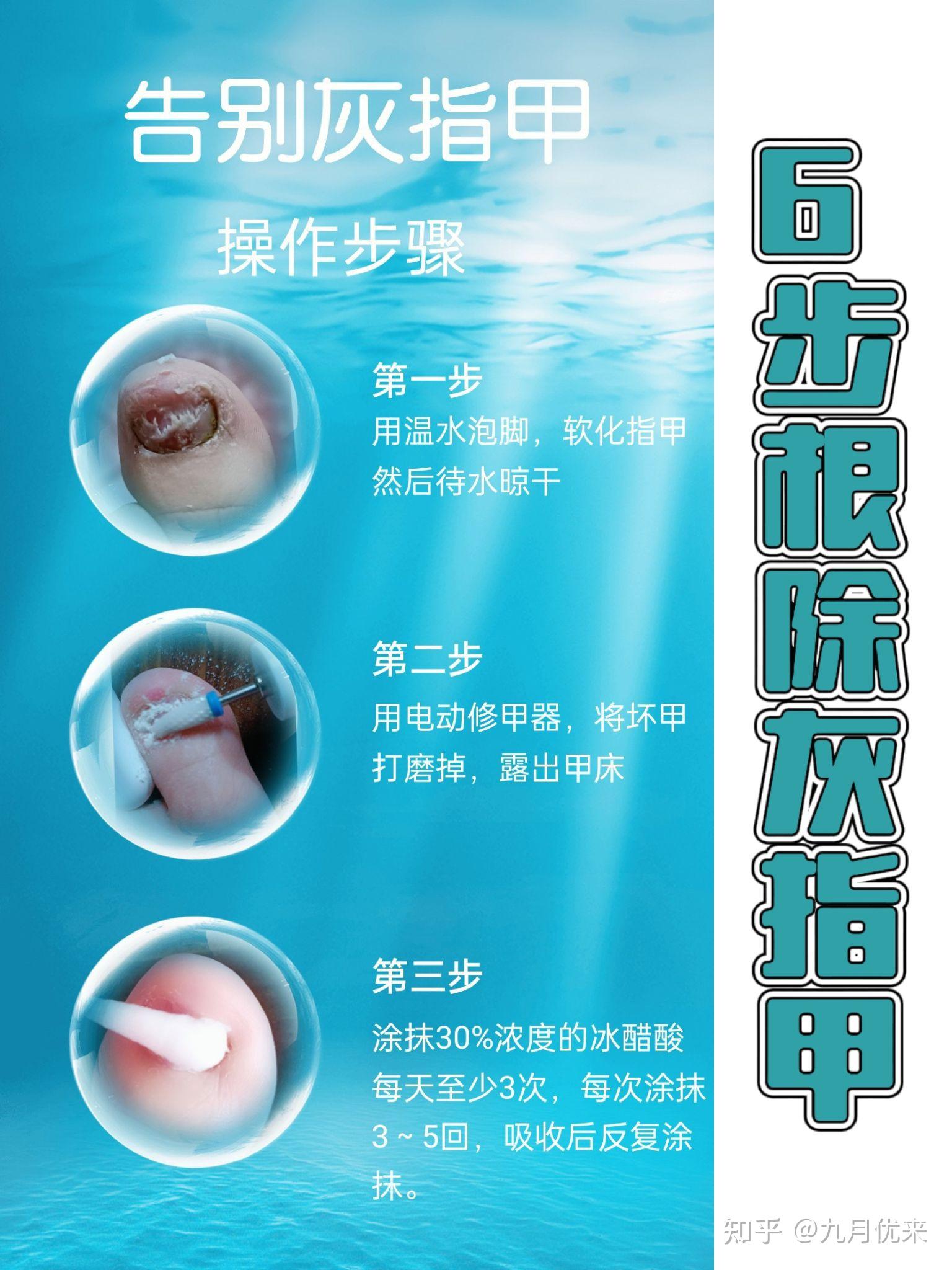 用30%的冰醋酸，根除了6年的灰指甲，实拍记录方法分享