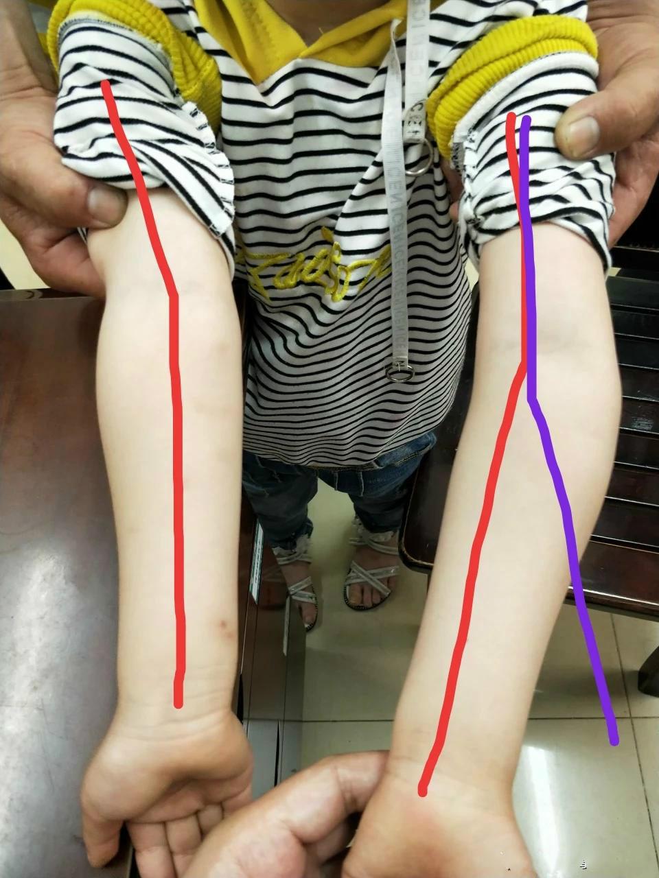 家长讳疾忌医导致孩子手臂畸形现在后悔莫及