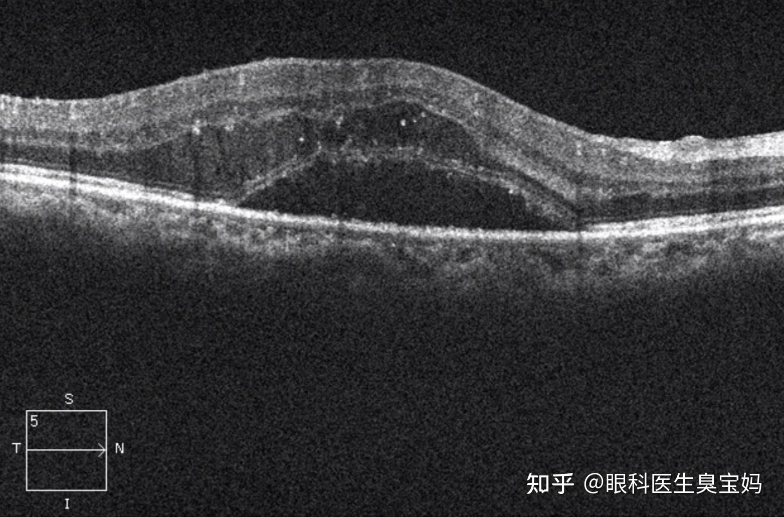 oct:可快速无创检查黄斑区有无水肿及水肿的厚度,范围.