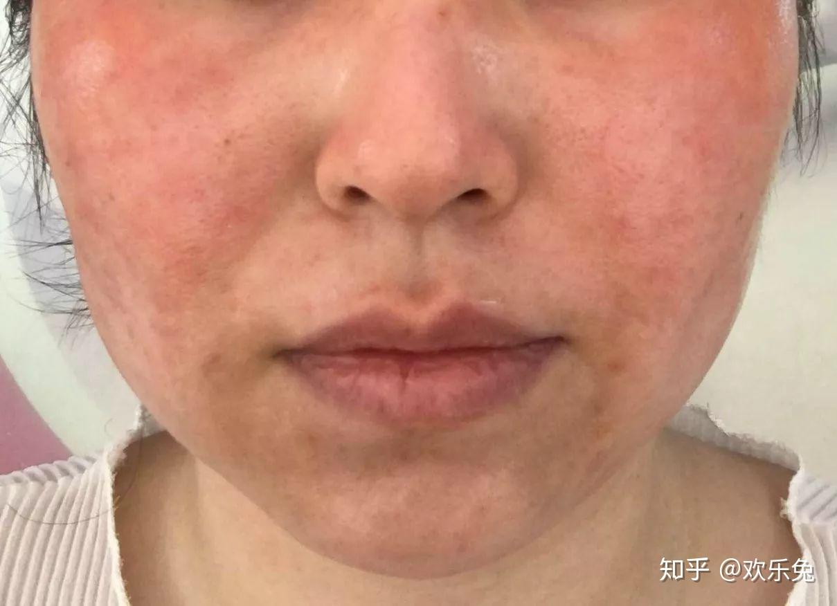 余翠玉护肤之激素产品被曝光,连明星都不慎踩坑了,你还傻傻追明星产品