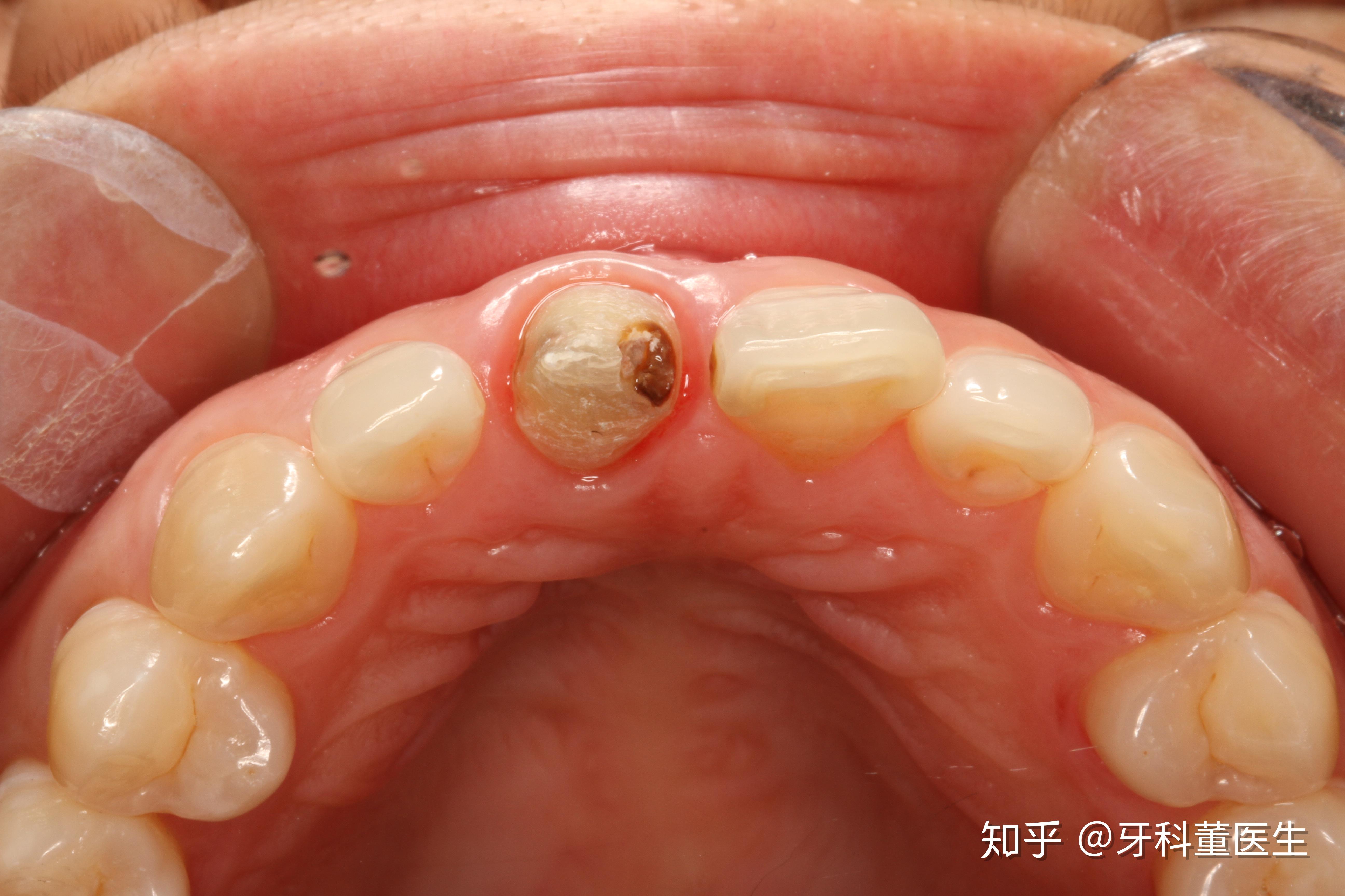 门牙根管治疗后图片图片