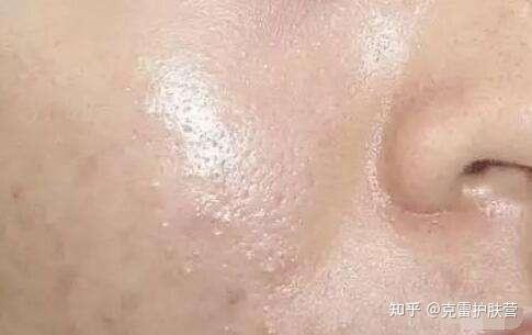 肤质可分为干性皮肤,中性皮肤,油性皮肤,敏感皮肤,混油皮肤,混干皮肤