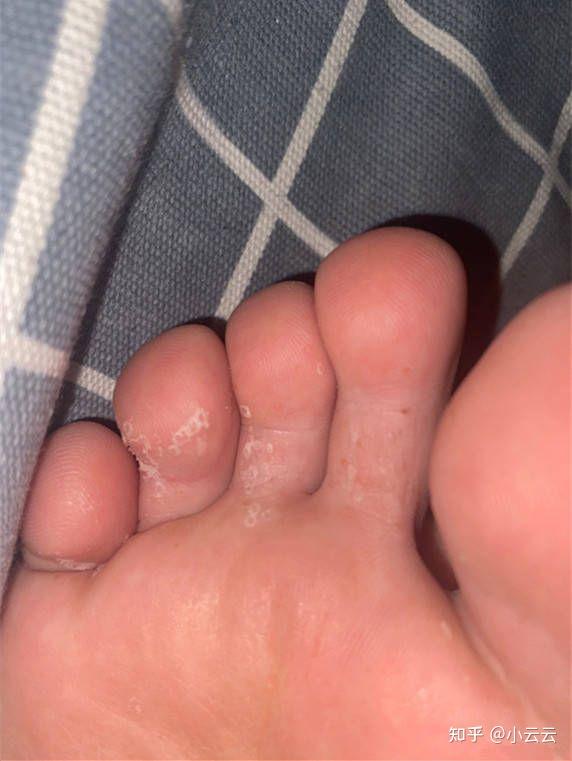 脚气会传染到身体其他部位吗?还真会!注意了