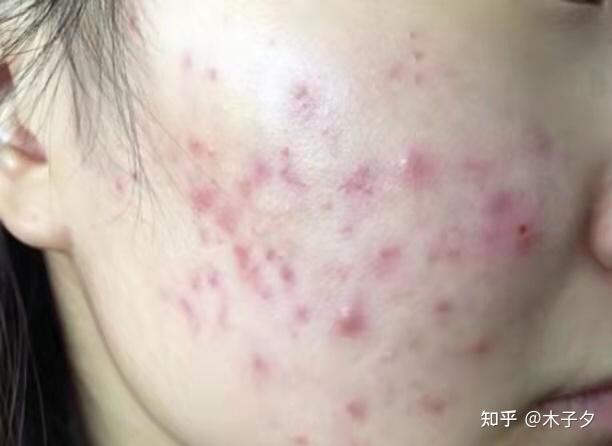 针清#祛痘# ，那么针清到底是什么 - 知乎
