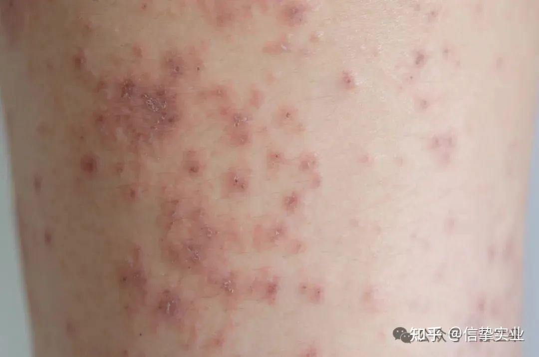3种皮肤病又红又痒,千万别抓！医生教你：对图自查(附治疗方法) - 知乎
