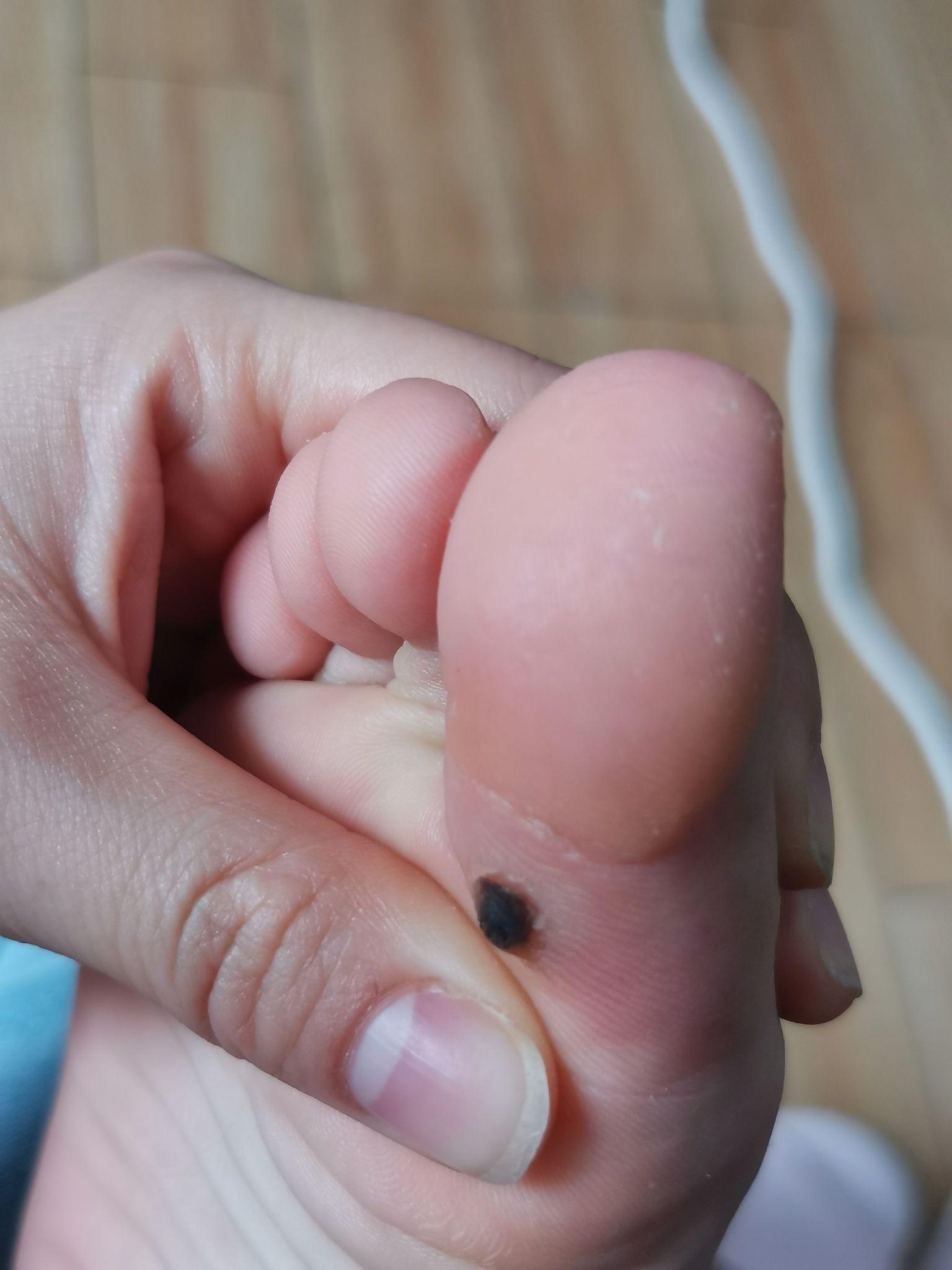 跖疣脱落过程 - 知乎