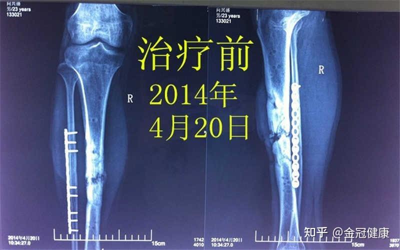 骨不连患者病例介绍附骨不连的影响因素