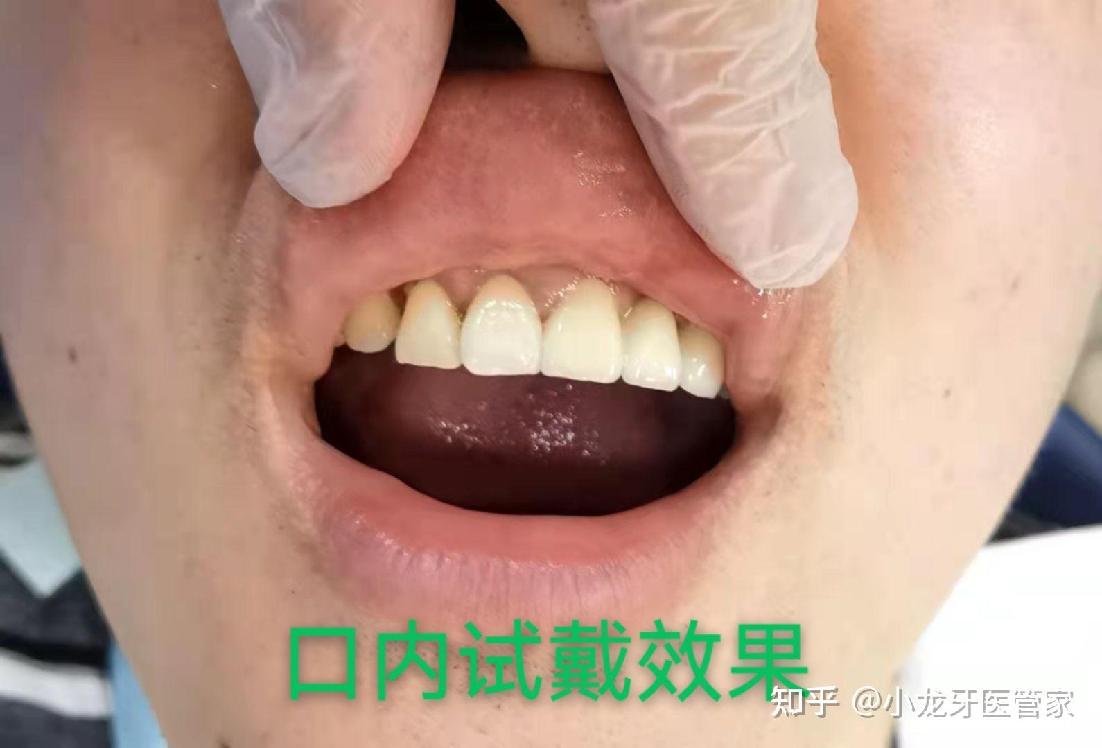 缺了牙，哪些修复方法供你选__凤凰网