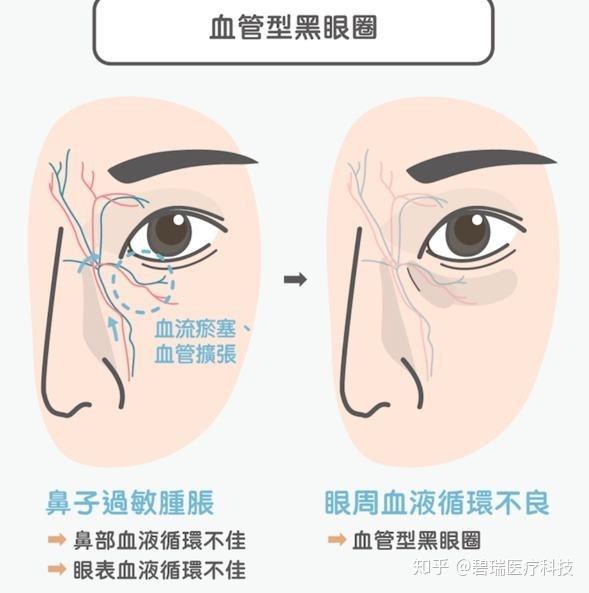 我平时已经尽量不熬夜了 黑眼圈 咋还越来越重呢 知乎