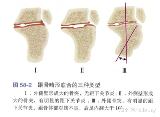 足部骨折畸形愈合