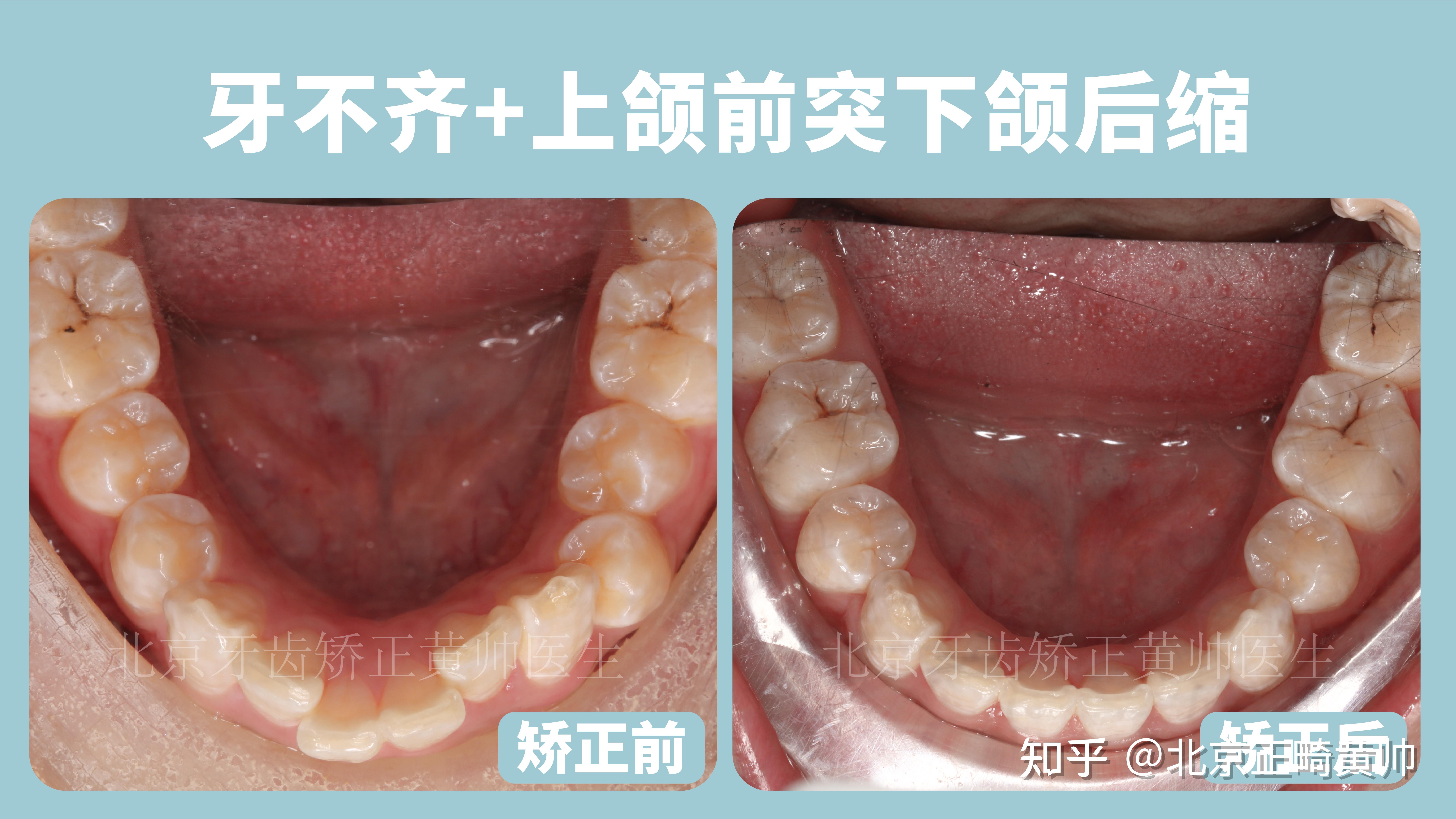 牙齿正常倾斜角度图图片