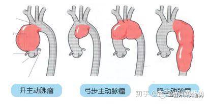 主动脉疾病微创治疗常见问题解答 知乎