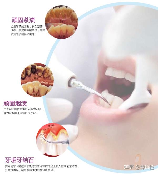 超声波洁牙器真的可以祛除牙结石吗 超声波洁牙器对牙齿有没有伤害 21年超声波洁牙器推荐 选购指南 知乎