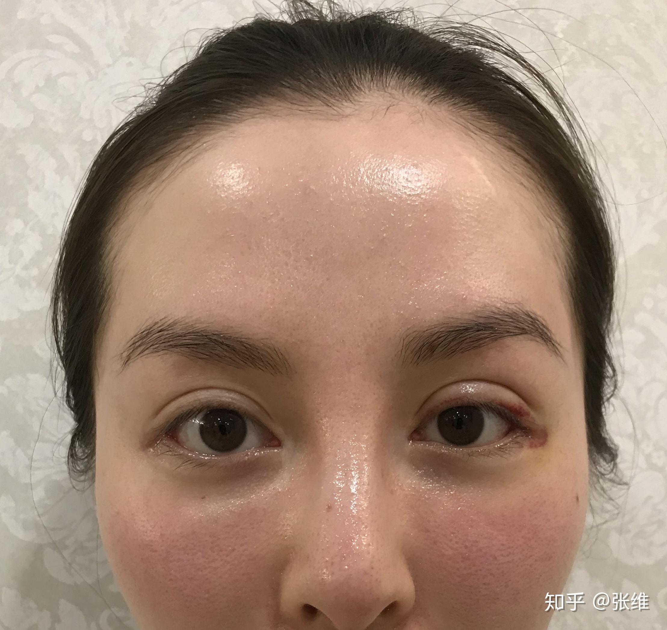 双眼皮线两侧不对称怎么办