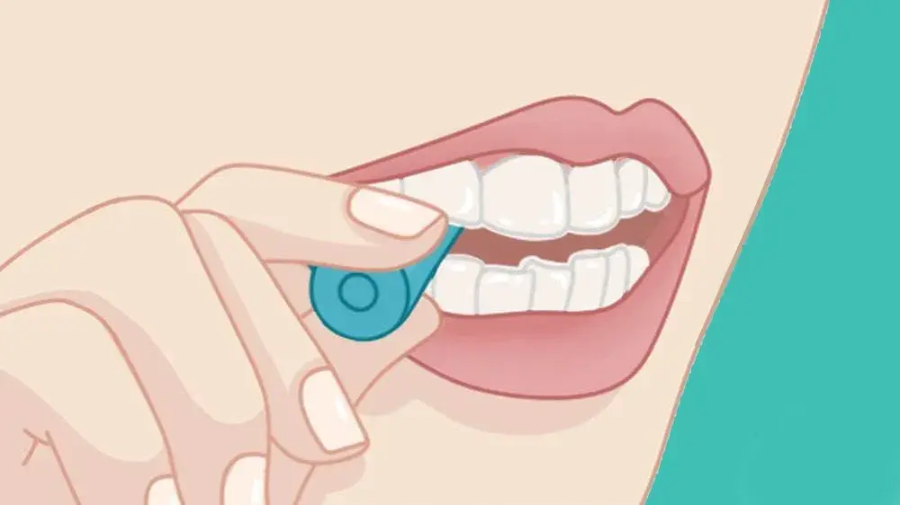 隐形牙套初戴注意事项你想知道的这里都有