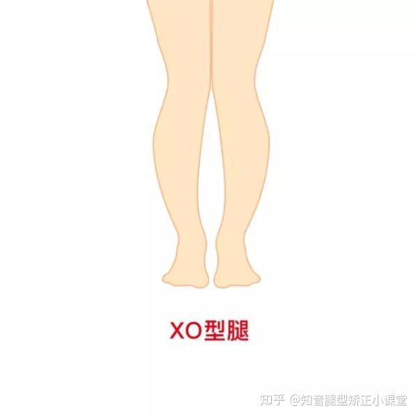 xo型腿是在双足并拢放松直立时,双膝可以并拢,但小腿中段无法接触