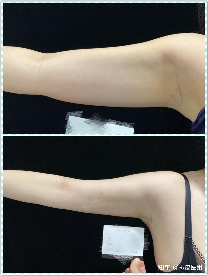 一般是手臂和大腿吸脂做的比较多,负压和水动力都用的不错.