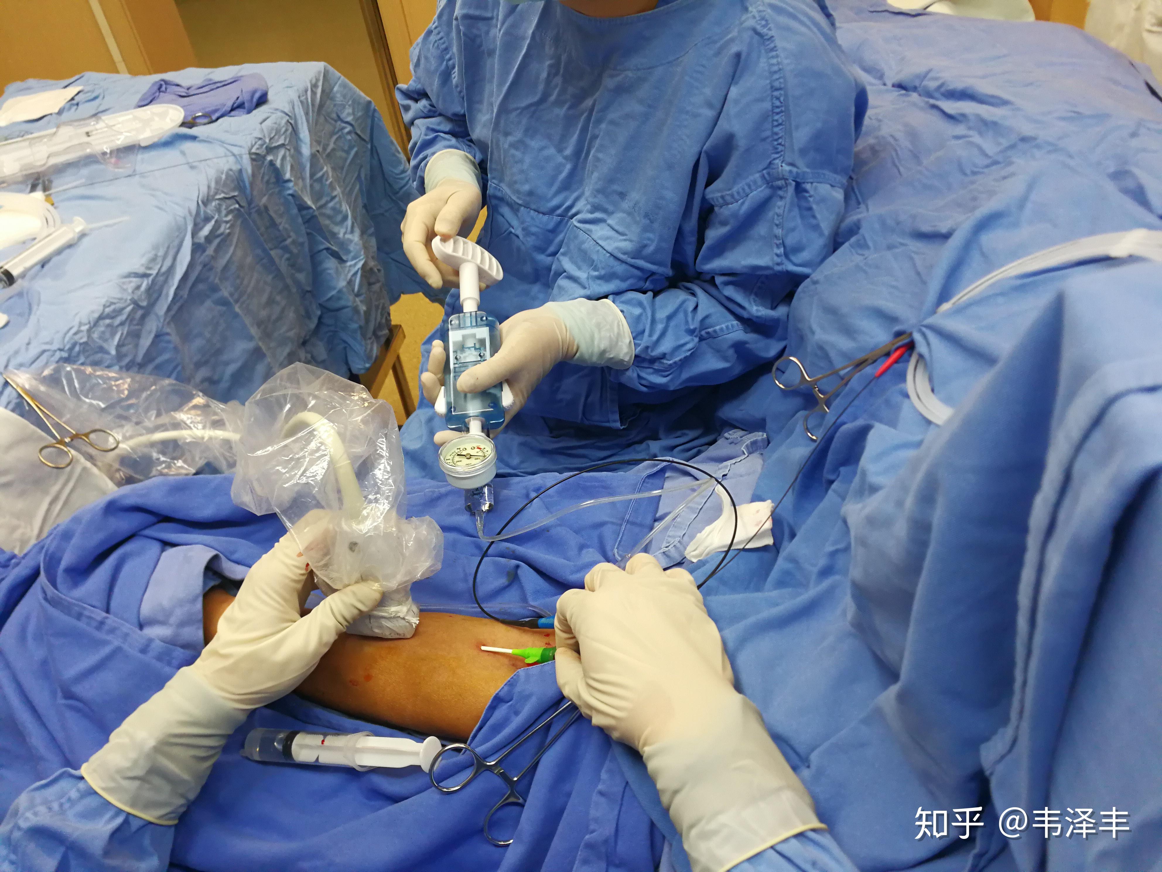 b超引导下内瘘溶栓球囊扩张术