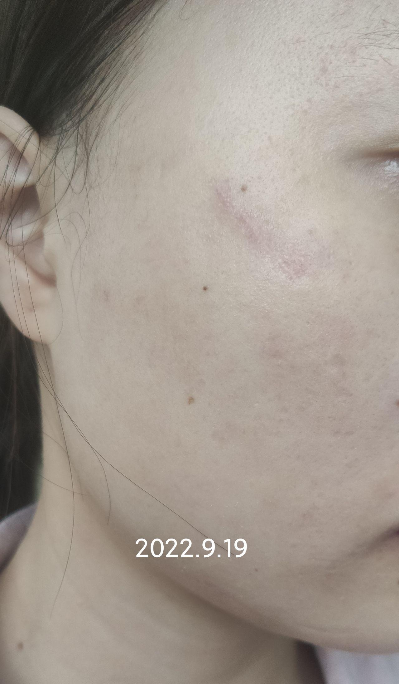 面部凹陷性疤痕修复自体脂肪填充1次3次点阵激光1次手术切缝