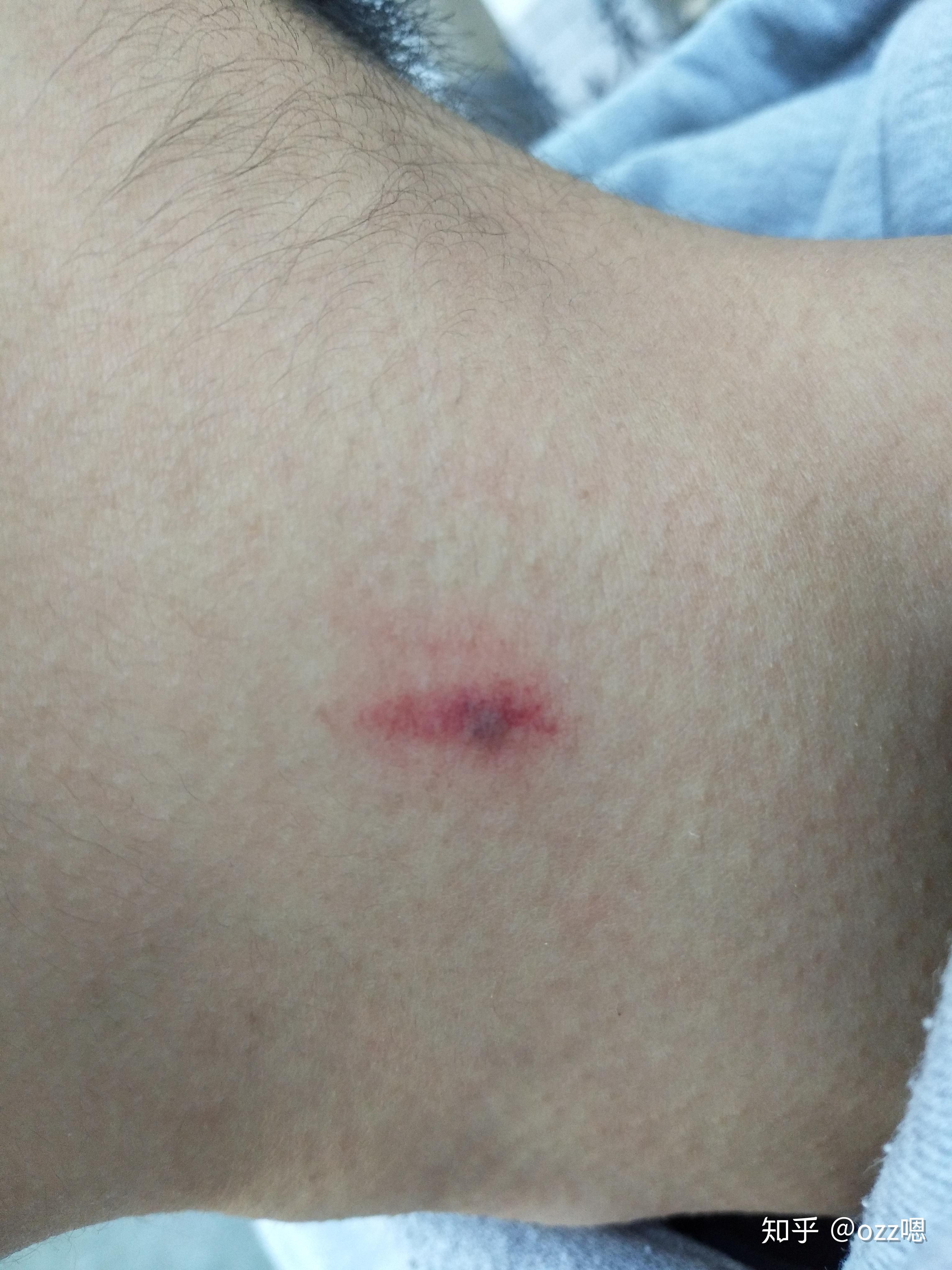 在男友(女友)脖子胸上种"草莓"真的很容易吗? - 知乎