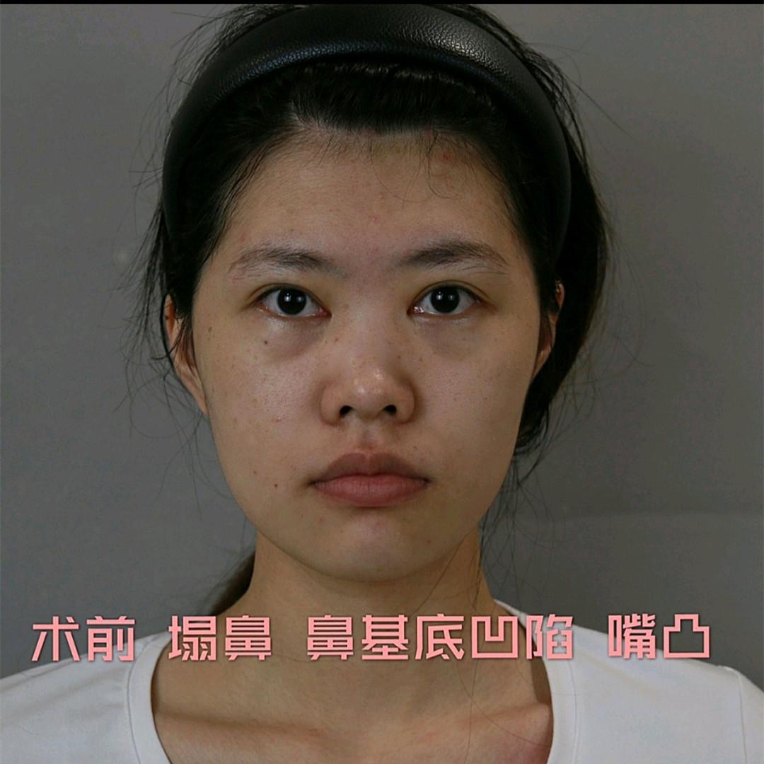 做鼻子比较出名的医生_做鼻子好的专家_出名鼻子医生比较做的是什么