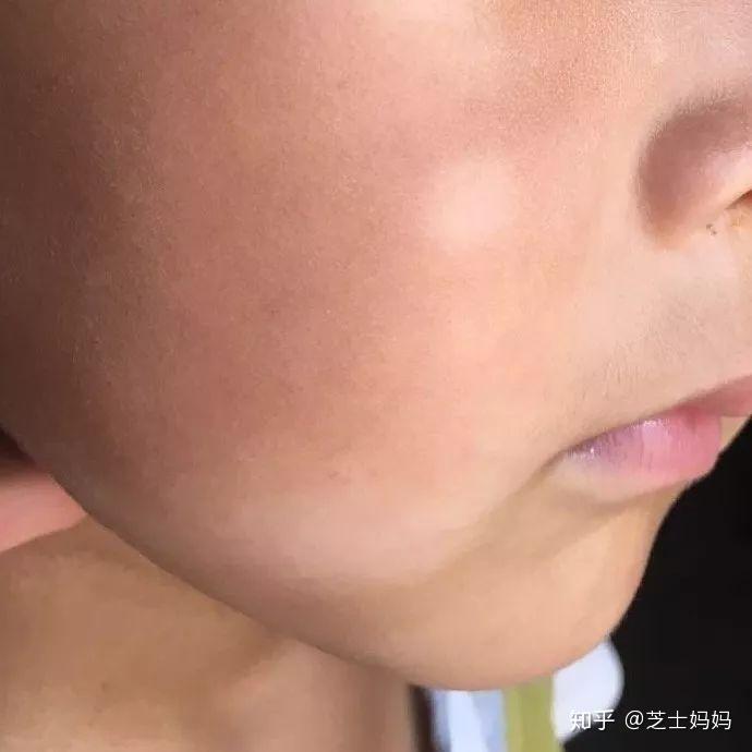 宝宝脸上或身上出现白斑,到底是什么?会是白癜风吗?
