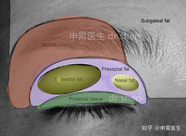 可以簡單分為眶隔脂肪優勢可眼輪匝肌下脂肪優勢組.