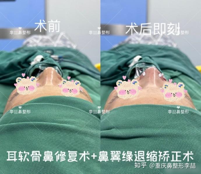 鼻翼缘退缩鼻孔外露 - 知乎