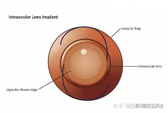 为什么做了白内障手术后又看不见了? - 知乎