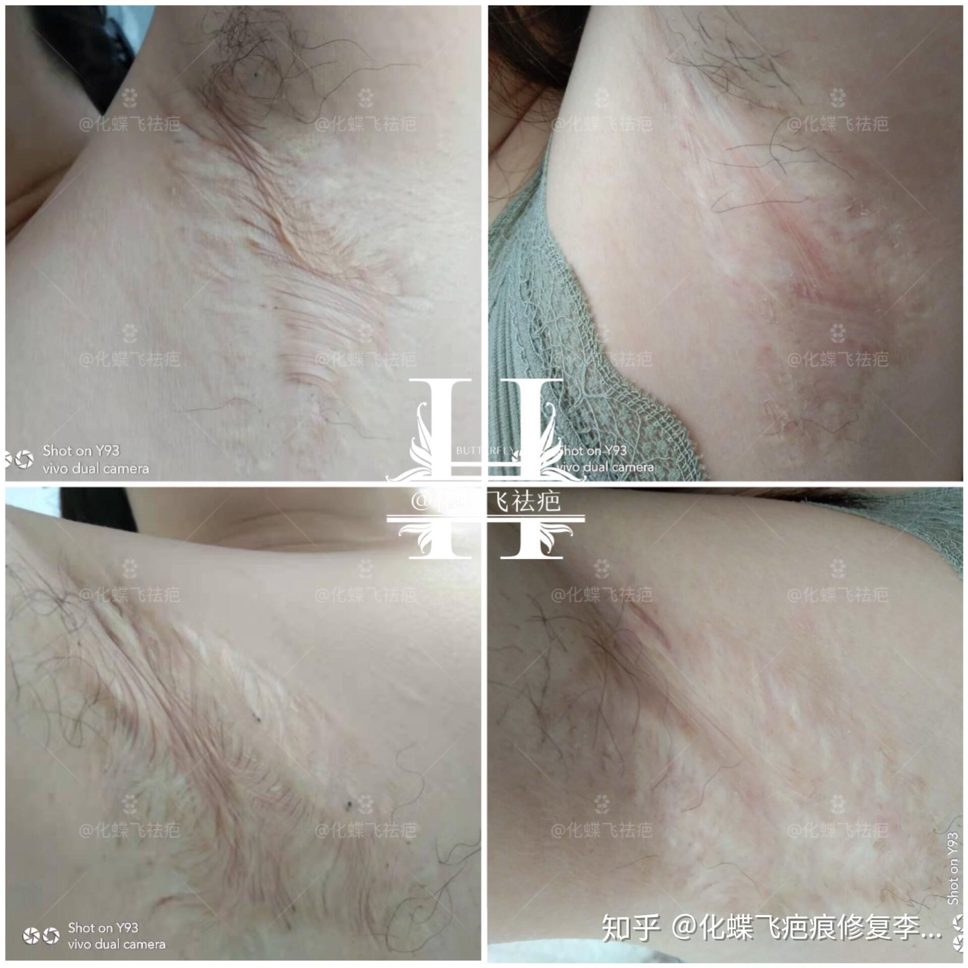 腋下疤痕涂中药修复的这个效果你觉得怎么样