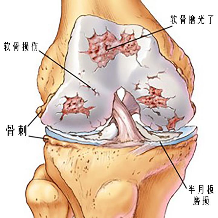 膝关节疼痛难忍 长 骨刺 了该怎么办 知乎 膝关节疼痛难忍 长 骨刺 了该怎么办 知乎