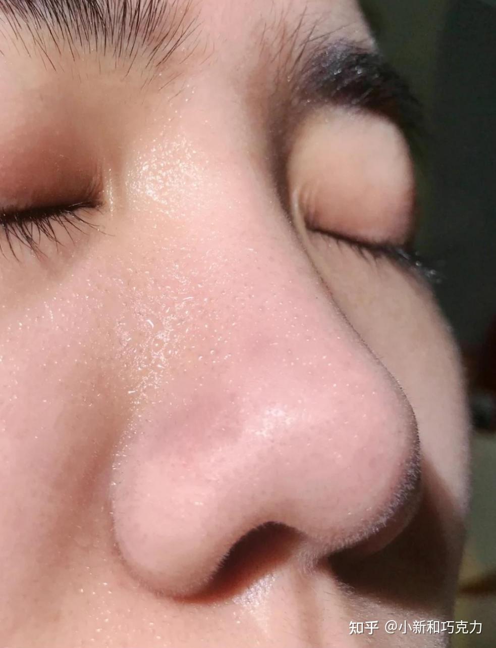 我有一个很严重的草莓鼻,有时候看到满鼻子的黑头,觉得自己的鼻子很丑