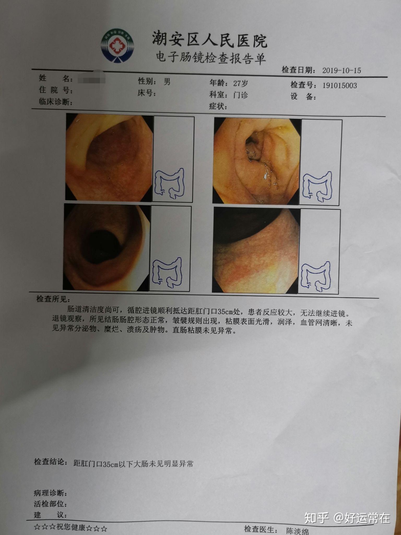 肠镜- 知乎