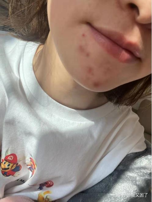 为什么姨妈期更容易爆痘,生理期痘痘该如何调节? - 知乎